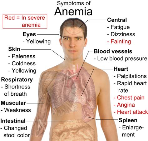 Anemia